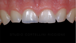 Denti erosi e consumati