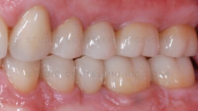 Ricostruzione delle corone dentali